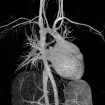 МР-коронарография сосудов сердца